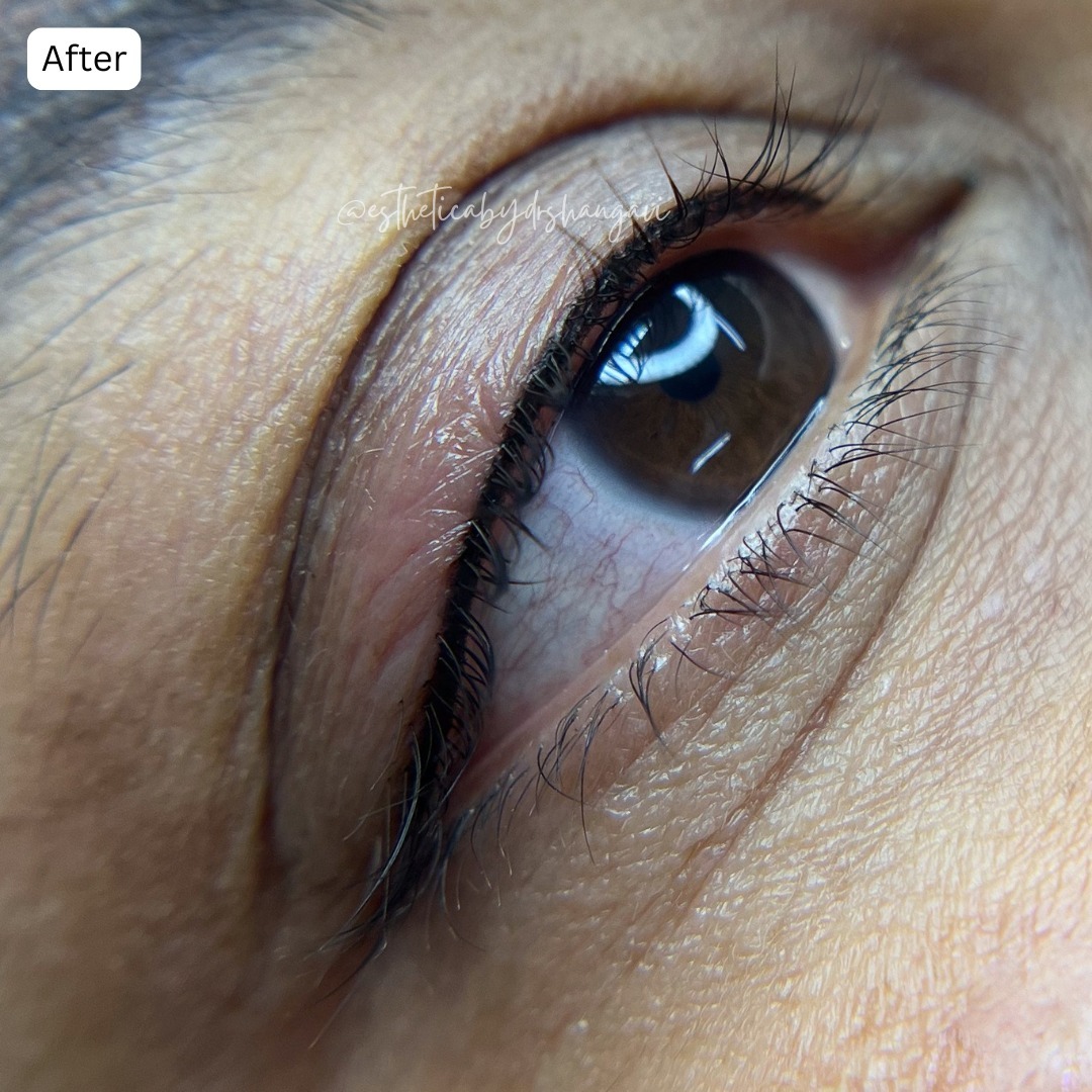 Permanent liner results Bangalore